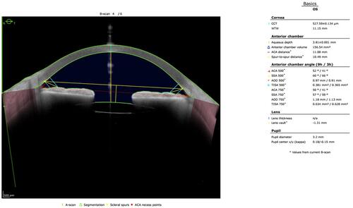 Figure 1 Pre-procedure Anterion® printout showing cornea, anterior chamber, lens, and pupil parameters.