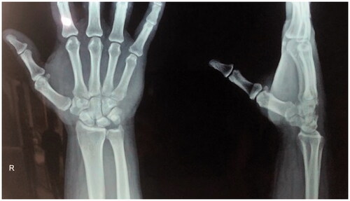 Figure 2. Follow up X-rays of wrist PA & lateral views CMC is in alignment.