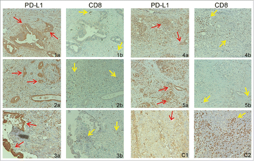 Figure 7. PD-L1 protein and tumor-infiltrating CD8+ T cell levels in human pancreatic carcinoma. Tumor tissue specimens from five human pancreatic cancer patients were stained with antibodies that are specific for human PD-L1 (1a–5a) and human CD8+ (1b–5b), respectively. Brown color indicates PD-L1 protein and tumor-infiltrating CD8+ T cells staining. The tissues were counterstained with hematoxylin. Each image represents representative image of one patient. Red arrows indicate tumor cells and yellow arrows point to tumor-infiltrating CD8+ T cells. (C1) Human Adrenal tumor tissue was used as a positive control for human PD-L1-specific antibody. (C2) Human tonsil tissue was used as a positive control for human CD8+-specific antibody.