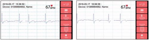 Figure 8. ECG monitoring through mobile phone and application.