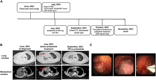 Figure 1 Summary of disease course, therapies, and molecular findings. (A) The entire treatment course; (B) Chest CT scans of the primary PSC at treatment milestones; red arrows indicate nodular thickening of the pleura. (C) Pleuroscopy revealed multiple neoplasms in the right parietal pleura, visceral pleura, and phrenic pleura.