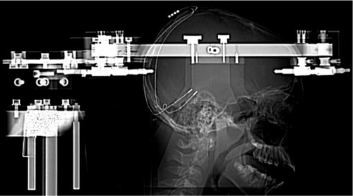 Figure 1 Lateral skull X-ray. Two deep brain stimulation electrodes (Medtronic model 3389; Minneapolis, MN, USA) were stereotactically implanted bilaterally from retromastoidal burr holes into the anterior lobe of the cerebellum.