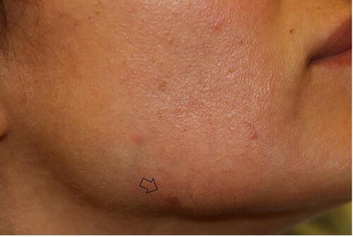 Figure 2 Facial follicular hyperkeratotic spicules after three weeks of treatment with 5% permethrin.