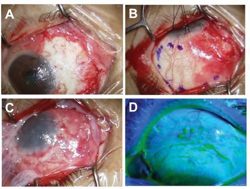 Figure 4 Photographs showing surgical procedures in a 57-year-old woman in the representative case report.