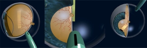 Figure 3 3D eye models displaying different echographic positions and screening of lesions.