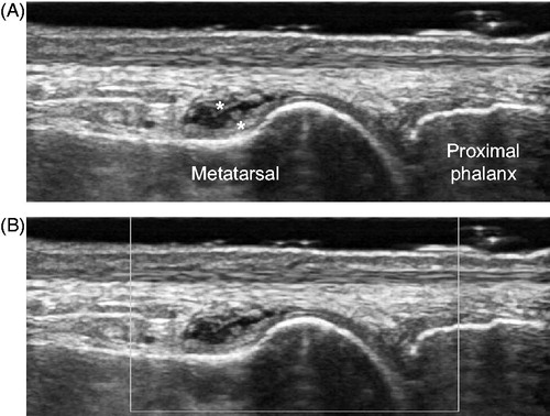 Figure 2. Representative images of non-specific thickening of synovial membrane. Dorsal aspect of metatarsophalangeal joint in the right first toe, longitudinal view. (A) gray-scale image and (B) power Doppler image. Asterisks indicate non-specific thickening of synovial membrane.