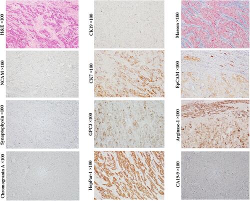 Figure 4 Example case of a fibrolamellar HCC originated from the later HCP. A 19-year-old female patient with 10.2 cm sized tumor in the left lobe of the liver. Her preoperative serum AFP was 118.6 ng/mL. There was no recurrence in the first month after operation. Subsequently, the patient was lost to follow-up. H&E and Masson staining show large polygonal tumor cells with copious eosinophilic cytoplasm and abundant fibrous stroma arranged in parallel lamellae around the tumor cells. Tumor cells do not express NCAM, chromogranin, synaptophysin, CK19 and CA19-9, but express CK7 and EpCAM, and hepatocytic lineage markers, GPC3, arginase-1 and HepPar1, suggesting that the tumor can originate from the later HCP.