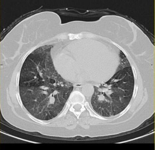 Figure 2 HCRT of chest for showing mosaic attenuation.
