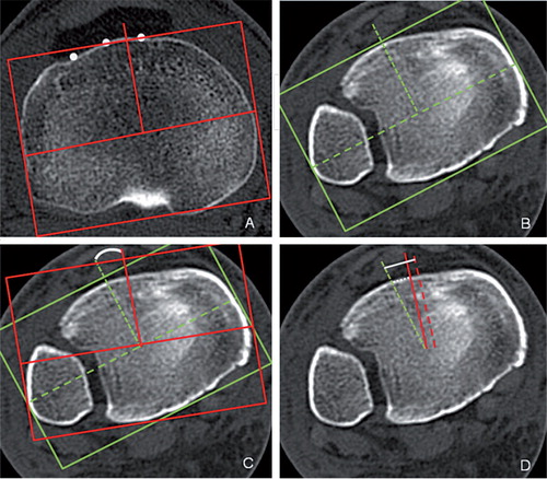 Figure 3. A. Axial scan showing proximal AP axis 1 passing through one-third of the tibial tuberosity (TT). B. Distal AP axis, i.e. the projection of the center of the ankle joint. C. Axial scan showing the mismatch in rotation alignment between proximal AP axis 1 (continuous red line) and the distal AP axis (dotted green line), the latter being externally rotated with respect to the former. D. Axial CT scan showing the extent to which, on average, the reference point of the ankle joint should be translated medially to compensate for tibial torsion (white dotted line) and for tibial torsion plus the difference in malleolar width (white continuous line).