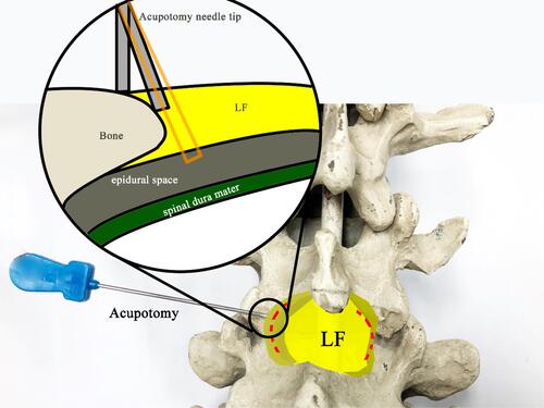 Figure 6 The needle-knife area stripped and peeled four or five times to form the cut trace of a discontinuous line and needle-tip operation on the bone surface without a feeling of falling to avoid puncturing the spinal dura mater. LF, ligamentum ﬂavum. Orange rectangle: needle knife is not in the bone surface.