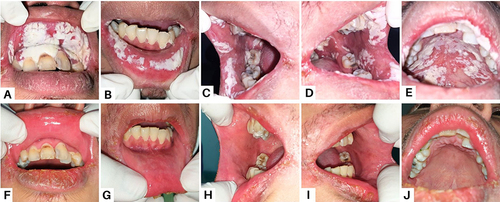 Figure 1 Intraoral appearance of the patient in Case 1 (A–E) There were “cottage cheese-like” lesions involving the entire oral cavity on the first visit (F–J) After two weeks, the lesions healed.