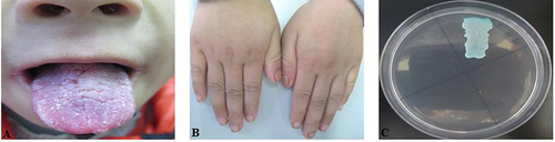 Figure 3 Patient No.3 (A) Image of oral mucosal of the child (B) Image of fingers of the child (C) Results of incubation on SDA at 37°C from the oral mucosal of the patient.