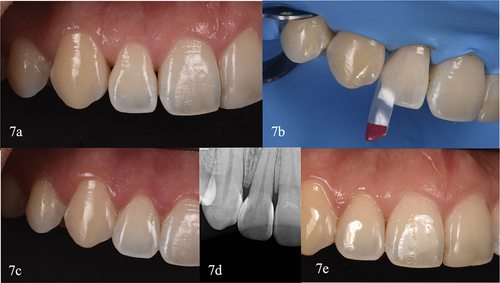 Figure 7. Clinical case V. (a) Detail of de initial intraoral lateral view. (b) Detail of the isolated teeth, the large red one can be seen in place, the distal right lateral embrasure. (c) Two weeks clinical control. (d) Radiographic control at two weeks. (e) Two years review, highlighting the restorations integrity.