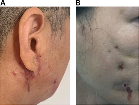 Figure 5 Facial redness and swelling of Case 2 (A) and Case 3 (B). Swelling and cracks were visible on the cheeks, ears, and neck. Both patients had a visible scar on their face and ear, which appeared dark red and uneven.