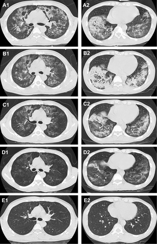 Figure 1 Chest CT performed on admission (A1, A2), on day 9 (B1, B2), on day 17 (C1, C2), on day 26 (D1, D2), and five months after discharge (E1, E2).