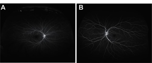 Figure 3 (A and B) Ultra-widefield fluorescein angiography pattern one.