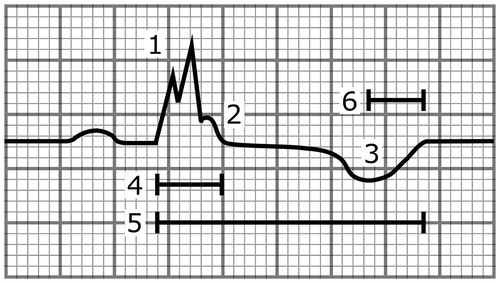 Figure 4. A schematic illustration showing a heartbeat with multiple abnormalities that are associated with increased SCD risk. These include (1) the fragmentation of the QRS complex, (2) the notched ER pattern with a downsloping ST segment, (3) the T-wave inversion directed to the opposite direction from the QRS complex, (4) the wide QRS complex (110 ms), (5) the long-QT interval (500 ms), and (6) the long T-peak to T-end interval (105 ms). The paper speed is 50 mm/s.