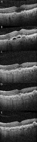 Figure 2 OCT of Patient Response to anti-VEGFs. (A) A 72 year old male initially presented with dry intermediate age-related macular degeneration (ARMD) and 20/30 vision. (B) He then developed neovascular ARMD with subretinal fluid on optical coherence tomography (OCT) that was treated with a total of 9 intravitreal ranibizumab injections. The fluid resolved but recurred when the interval was extended beyond 4–6 weeks (C). He then received a total of 25 aflibercept injections but again developed recurrent subretinal fluid at 4–6 weeks (D). He was subsequently treated with intravitreal faricimab, had fluid resolution after 3 monthly injections, and has not had any recurrence on a treat and extend regimen, currently at 12 weeks, with 20/20 vision (E).