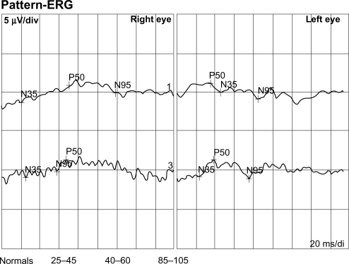 Figure 3 Pattern ERG of the patient showing reduced response.