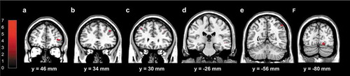 Figure 3. Results of the fMRI analysis. Regions showing significant activations associated with the Judgment task specific to the DIFF group on Post-run (Post-DIFF > Post-SAME; p < 0.05, corrected for FWE by voxel level inference): (a) right middle orbital gyrus, (b) right middle frontal gyrus, (c) left middle frontal gyrus, (d) right middle temporal gyrus, (e) right inferior parietal lobule, and (f) right cerebellum. Those activations were overlayed on the Colin27 template that was provided by MRIcron software (http://people.cas.sc.edu/rorden/mricron/index.html). The color-bar indicates the t-value for each activation.