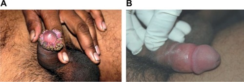 Figure 8 Effect of MIP on ugly anogenital warts.