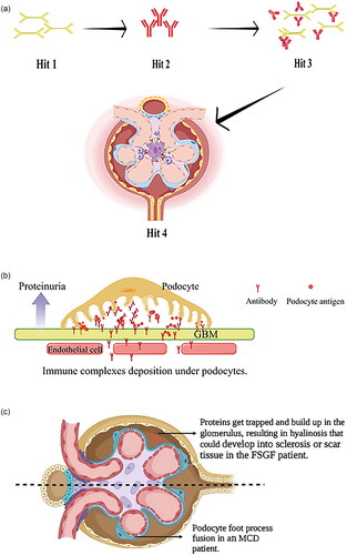 Figure 2. The current widely accepted pathogenesis and pathological characteristics of several glomerular diseases. (a) The popular theory of “four blows” on the pathogenesis of IgA: hit 1, production of galactose-deficient lgA1; hit 2, production of anti-galactose-deficient lgA1 autoantibodies; hit 3, immune complex formation and deposition; hit 4, deposition of immune complexes in the mesangial area, activating the complement system and causing glomerular damage. (b) Depiction of immune complexes deposited under the epithelial cells of GBM, resulting in its thickening and podocyte injury, which could damage the barrier of glomerular filtration and cause further proteinuria. (c) Depiction of glomerular changes in patients with MCD and FSGS. The glomerular lesion of the former is mild, while that of the latter shows local sclerosis. GBM: glomerular basement membrane.