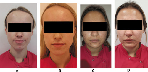 Figure 2 Example participant: (A) AA group, before treatment; (B) AA group, after treatment (C) PA group, before treatment; (D) PA group, after treatment.