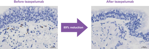 Figure 5 Micrograph images of airway eosinophils (brown staining) from CASCADE, before and after treatment with tezepelumab.