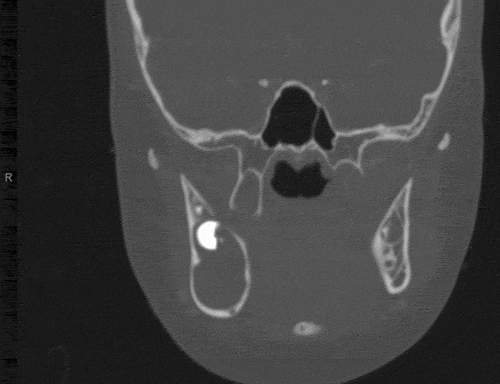 Figure 3. Coronal CT image demonstrating the vertical size (approximately 3 cm) of the expansile, unilocular radiolucent lesion of the right posterior mandible. The image also shows the posteriorly displaced crown of the second molar.