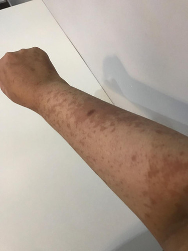 Figure 3 Picture of right forearm two months after discharge from the hospital: again, resolution of erythema multiform rash can be appreciated.