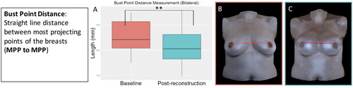 Figure 12. The bust point distance measurement (most projecting point to most projecting point) for the participants who underwent bilateral implant-based reconstruction significantly decreased after implant-based reconstruction (p = 0.003). (A) Boxplot of the bust point distance measurement at baseline and post-reconstruction (median and interquartile range). (B) The bust point distance measurement on an exemplar patient at baseline. (C) The bust point distance measurement on the same patient post-reconstruction.