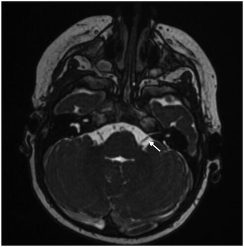 Figure 1. Magnetic resonance imaging of a case with vestibulocochlear nerve aplasia, Casselman grade 1. Arrow points to the facial nerve.