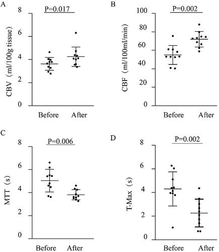 Figure 2 Preoperative and postoperative hemodynamics changes in the blood supply area of the middle cerebral artery (MCA) on the same side of the occlusion. Change in cerebral blood volume (CBV) (A), change in cerebral blood flow (CBF) (B), change in mean transit time (MTT) (C), change in time to top (T-Max) (D).