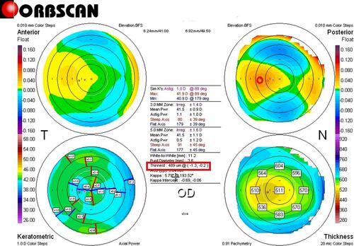 Figure 2 Pre-E-LAK-SCAP (post-LRS) Orbscan map of case 1. Right bottom pachymetric map: an example of measuring the differences in thickness between symmetrically opposed points is shown on the pachymetric map (0–180°, 45–225°, 90–270°, and 135–315°): 0–180°: 60 µm; 45–225°: 60 µm; 90–270°: 21 µm; 135–315°: 6 µm; total: 147 µm. Right top map: shows the measured distance between the maximum posterior elevation (best-fit-sphere; BFS) and the visual axis. Corneal apex: temporally deviated (right upper red circle). The thinnest point (X, Y) is indicated by the lower red square.