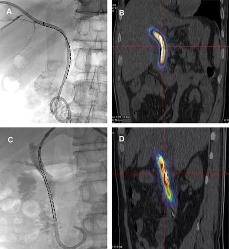 Figure 3 (A, B) Single 125I seeds strand combined with self-expandable metallic stent (SEMs) for malignant obstructive jaundice (Control group); (C, D) a novel brachytherapy biliary drainage catheter (BBDC group, double-strands) combined with SEMs for cholangiocarcinoma with malignant obstructive jaundice.