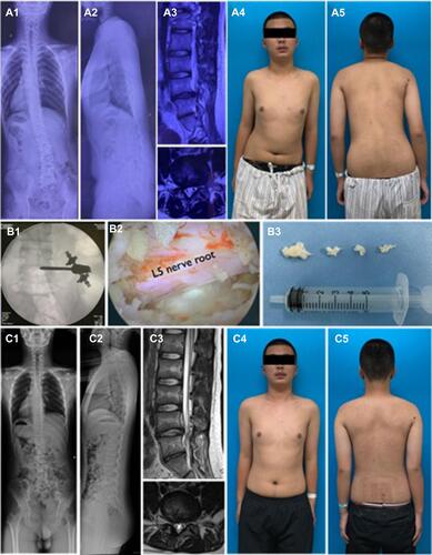 Figure 3 A 16-year-old male LDH patient with right leg sciatica present spinal sagittal and coronal imbalance (A1-2). L4/5 right side disc herniation was shown in MRI (A3). X-ray (A1-2) and physical appearance (A4-5) showed the trunk shifted to left side in coronal plane and forward in sagittal plane. UBED surgery was performed (B1-B3) and postoperative MRI showed herniated disc was removed (C3). X-ray (C1-2) and physical appearance (C4-5) showed coronal and sagittal imbalance acquired recovery immediately after surgery.