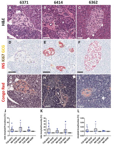 Figure 1. Islets with severe amyloidosis in patients with type 1 diabetes. Representative islets are shown from donors 6371 (A, D, G), 6414 (B, E, H), and 6362 (C, F, I). Serial sections were stained by h&e (A-C), double immunohistochemistry for insulin (red) and Ki67 (brown) (D and F), triple immunohistochemistry for insulin (red), glucagon (yellow) and Ki67 (black) (E), and Congo Red for amyloid (G–I). Islet amyloid prevalence ranged from 0–12.6% (J), and islet amyloid severity within only amyloid positive islets per section ranged from 0–41.2% (K) in the donors with type 1 diabetes. The overall amyloid area/total section area (%) in donors with type 1 diabetes was exceedingly small, ranging from 0–0.045% (L). Three non-diabetic matched control donors (ND 6318, 6238, and 6339) had no amyloid positive islets in any section examined (J–L). Scale bars: 100 µm (A–I). Whole slide images are available through the nPOD Online Pathology Database (https://www.jdrfnpod.org/for-investigators/online-pathology-information/).