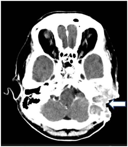 Figure 5. An Axial view of CT temporal before the radiotherapy shows enhancing soft tissue lesions occupying the residual mastoid cavity (arrow) and extending into the middle ear cavity.