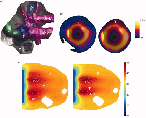 Figure 13. 3D patient-specific model and biothermal simulation for endoluminal hyperthermia treatment of a small pancreatic head tumor and surrounding anatomy (model IV): (a) deployed ultrasound applicator (A) (geometry III: two 1 cm OD × 0.5 cm long transducers, 3.4 MHz, 3.6 cm balloon aperture) is positioned in the pylorus stomach (S) adjacent to lumen wall and close to the pancreas head, and energy directed toward the pancreatic tumor, (b) temperature distribution across a transverse plane at a depth of 6 mm from aperture surface overlaid with model anatomy, when both the transducers are active (left) and when only the proximal transducer is active (right), (c) detailed temperature distributions with labeled 40 °C and 43 °C contours across a central axial plane, with both tumor (T) and pancreas (P) delineated, when both the transducers are active (left) and when only the proximal transducer is active (right). D: duodenum; SMA: superior mesenteric artery; SMV: superior mesenteric vein; SV: splenic vein.