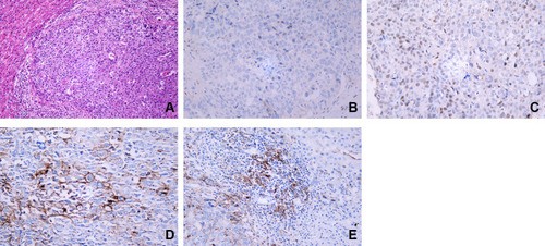 Figure 2 Pathological report revealed a diagnosis of SCC for case 2 (A). The IHC staining shows negative staining of CK7 (B) and the positive staining of P63 (C). PD-L1 expression on tumor cells was 10% (D), but its expression on tumor-associated immune cells was negative (E).