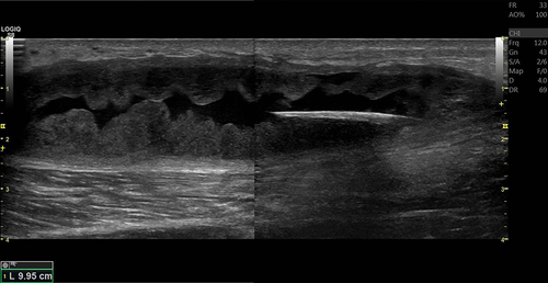 Figure 3 Ultrasound of a 35-year-old man with a wooden foreign body and abscess formation in the right leg shows an elongated hyperechoic structure representing the wooden foreign body within the thick-walled fluid collection in the subcutaneous layer of the right leg.