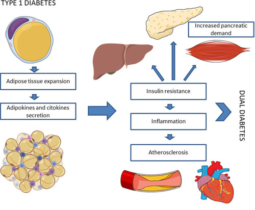 Figure 1 In patients with type 1 diabetes adipose tissue deposits produce adipokines and inflammatory cytokines that induce insulin-resistance contributing to the development of cardiometabolic complications. The coexistence of these clinical characteristics of type 2 diabetes in patients with type 1 diabetes has been referred to as double diabetes.