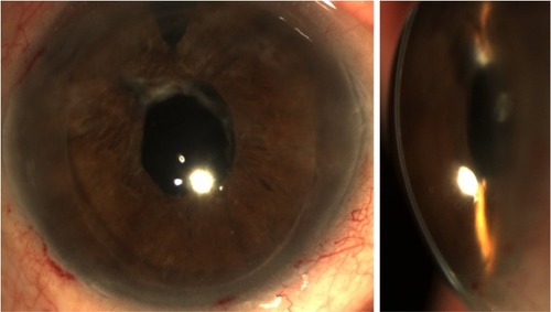 Figure 4 Slit-lamp images depicting the status following vitrectome-assisted removal of the fibrotic membrane at 2 months after UT-DSAEK. The anterior chamber appears clear and the pupil is round in shape.