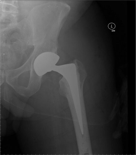 Figure 3 Immediate postoperative radiographs post total hip arthroplasty.