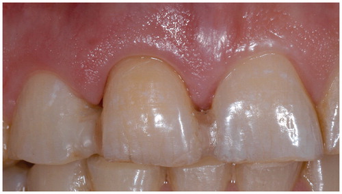 Figure 3. Natural tooth pontic which was attached to the adjacent teeth four weeks after treatment.