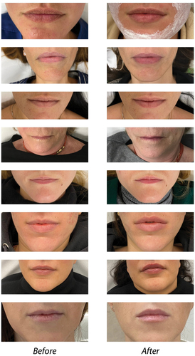 Figure 2. Representative images of patients taken before the first treatment (right panel) and during the follow-up meeting (left panel).
