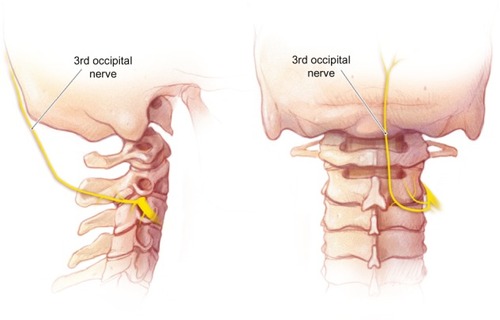 Figure 1 The course of the third occipital nerve as it traverses over the C2-3 facet joint.
