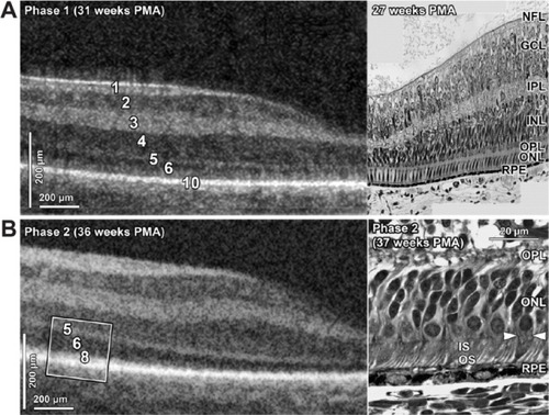 Figure 2 SDOCT histology comparison of normal premature infant retinas.
