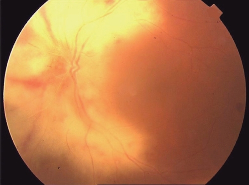 Figure 1 Color photograph showing retinitis with scatter retinal hemorrhages in the peripapillary area and along the vascular arcades. Fundal details appear blurred due to coexisting vitritis.