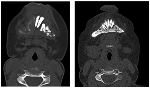 Figure 6. Axial cuts of the bone window of the patient before and after chemotherapy and steroid injection.